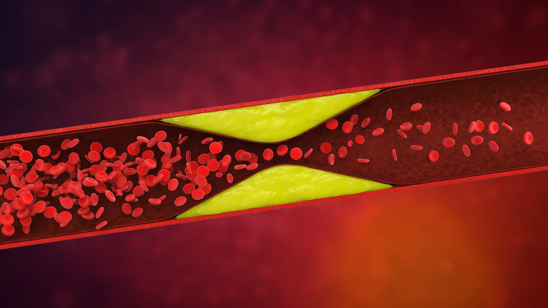 Hidden in your dna: The mutation combo that raises clot risk by 180%
