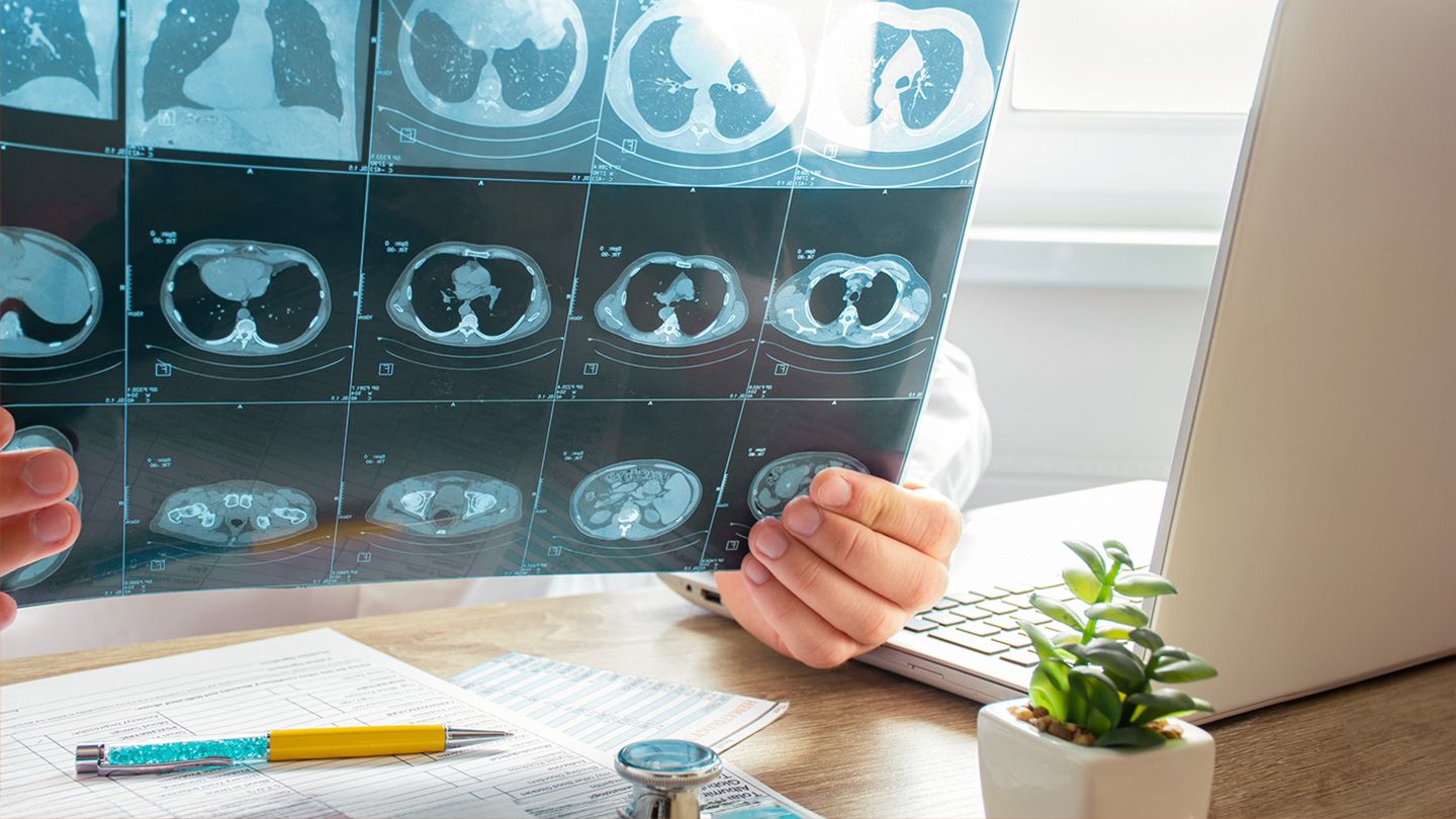 What Happens After a Lung CT Scan? What Happens After a Lung CT Scan?