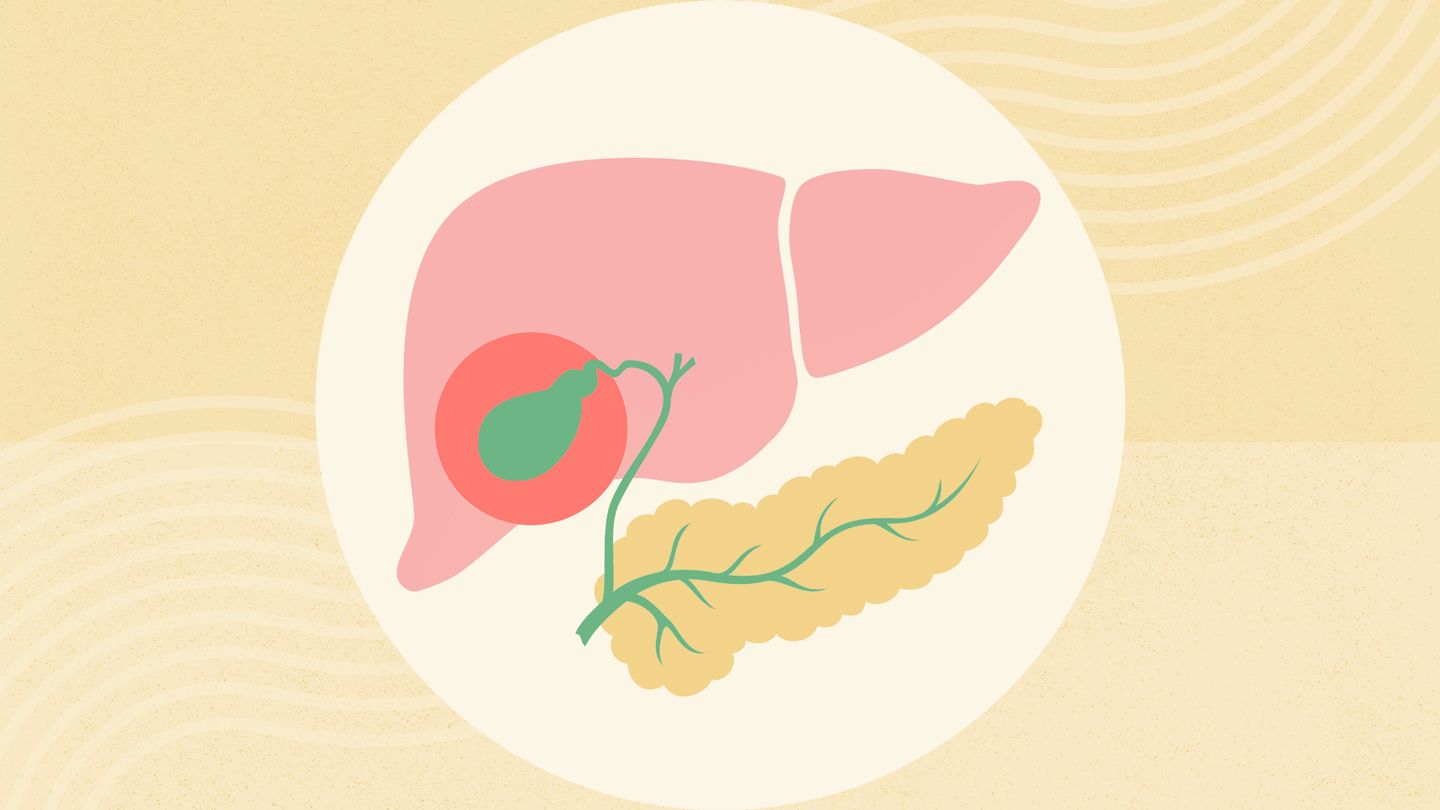 What Is Acalculous Cholecystitis? What Is Acalculous Cholecystitis?