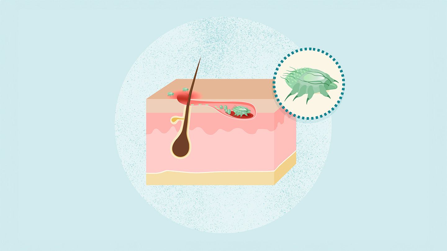 What Is Scabies? What Is Scabies?