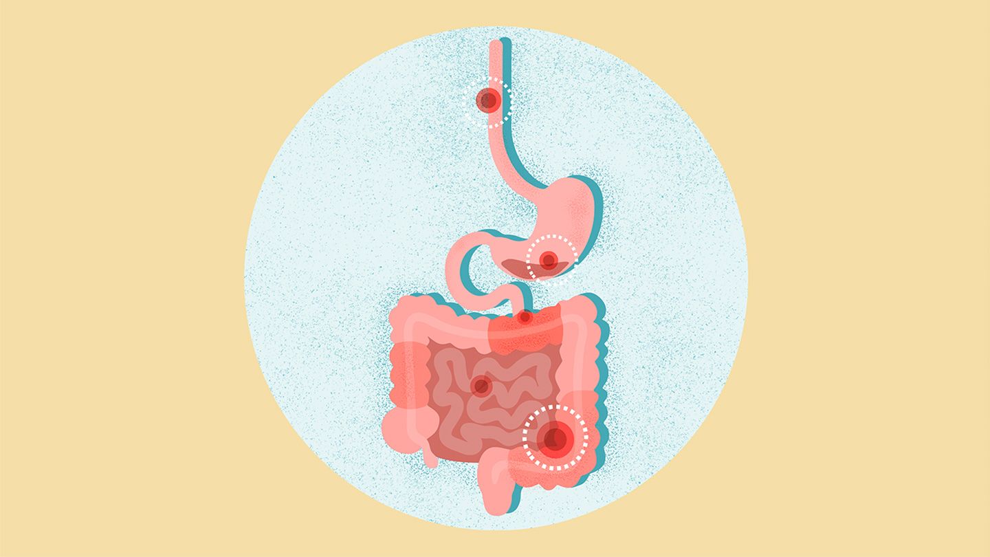 What Is a Gastrointestinal Perforation? What Is a Gastrointestinal Perforation?