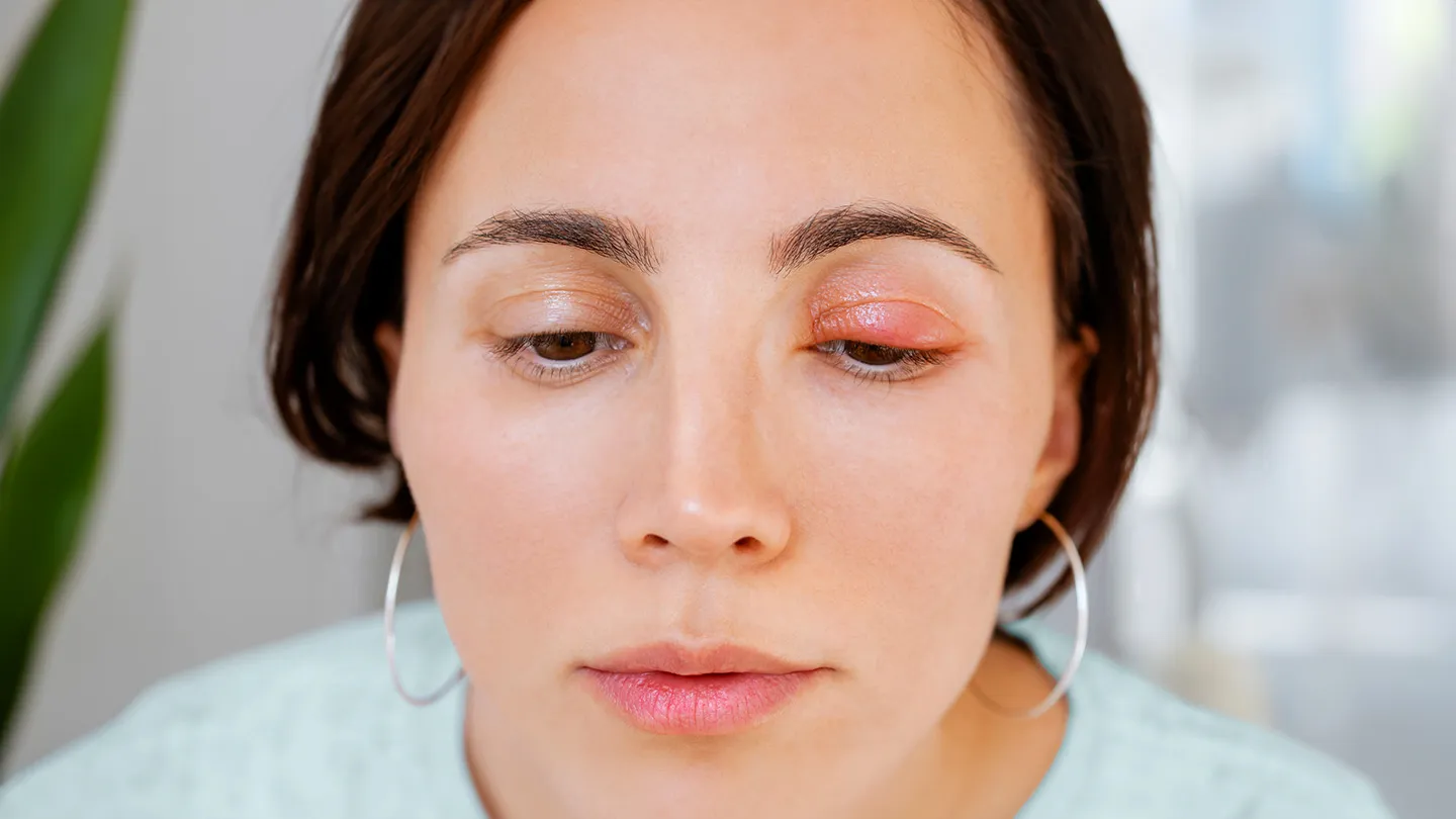 What Is a Stye? What Is a Stye?